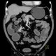 Carcinoid of terminal ileum, mesentery, desmoplastic reaction, prestenotic dilatation: CT - Computed tomography